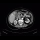 Carcinoma of gallbladder: CT - Computed tomography